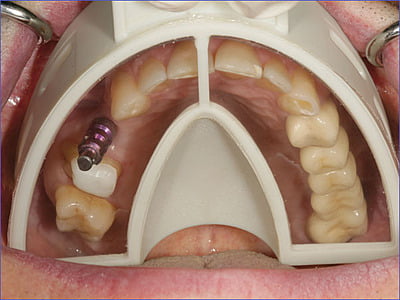 Miratray Implant - Cubetas para implantes