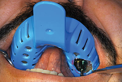 Miratray Implant - Cubetas para implantes Miratray Implant - Cubetas para implantes