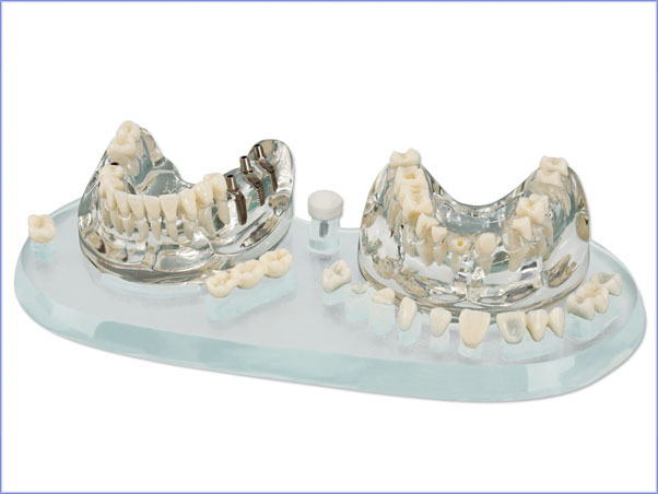 Tipodonto Study Model Demo Implant C+B