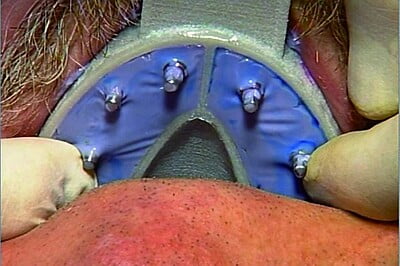 Miratray Implant - Cubetas para implantes Miratray Implant - Cubetas para implantes